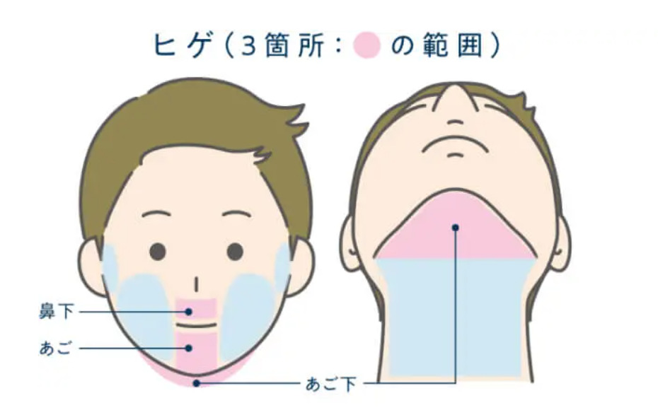 メンズアリシアクリニックのヒゲ脱毛の範囲