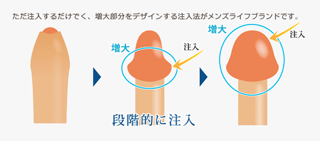 メンズライフクリニックの増大手術